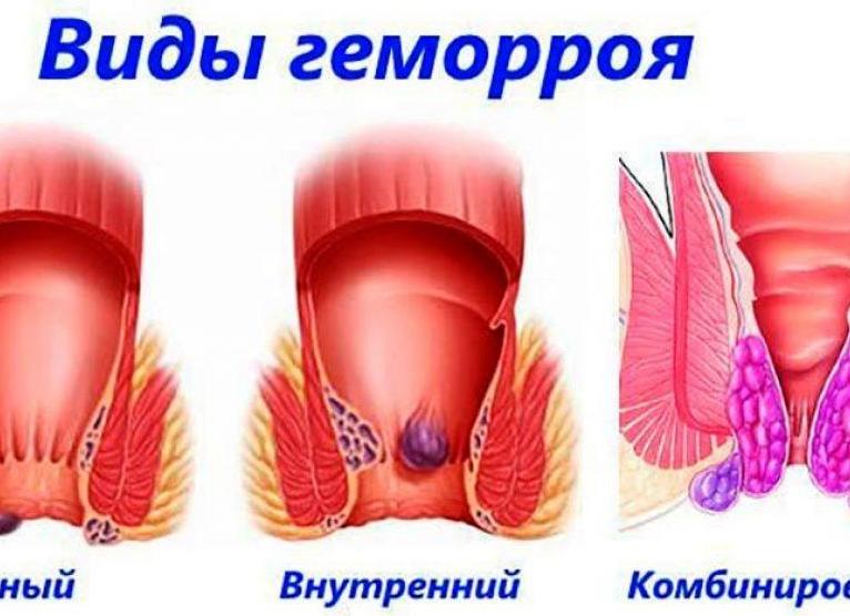Что делать, если обострился геморрой во время месячных, перед или после них?
