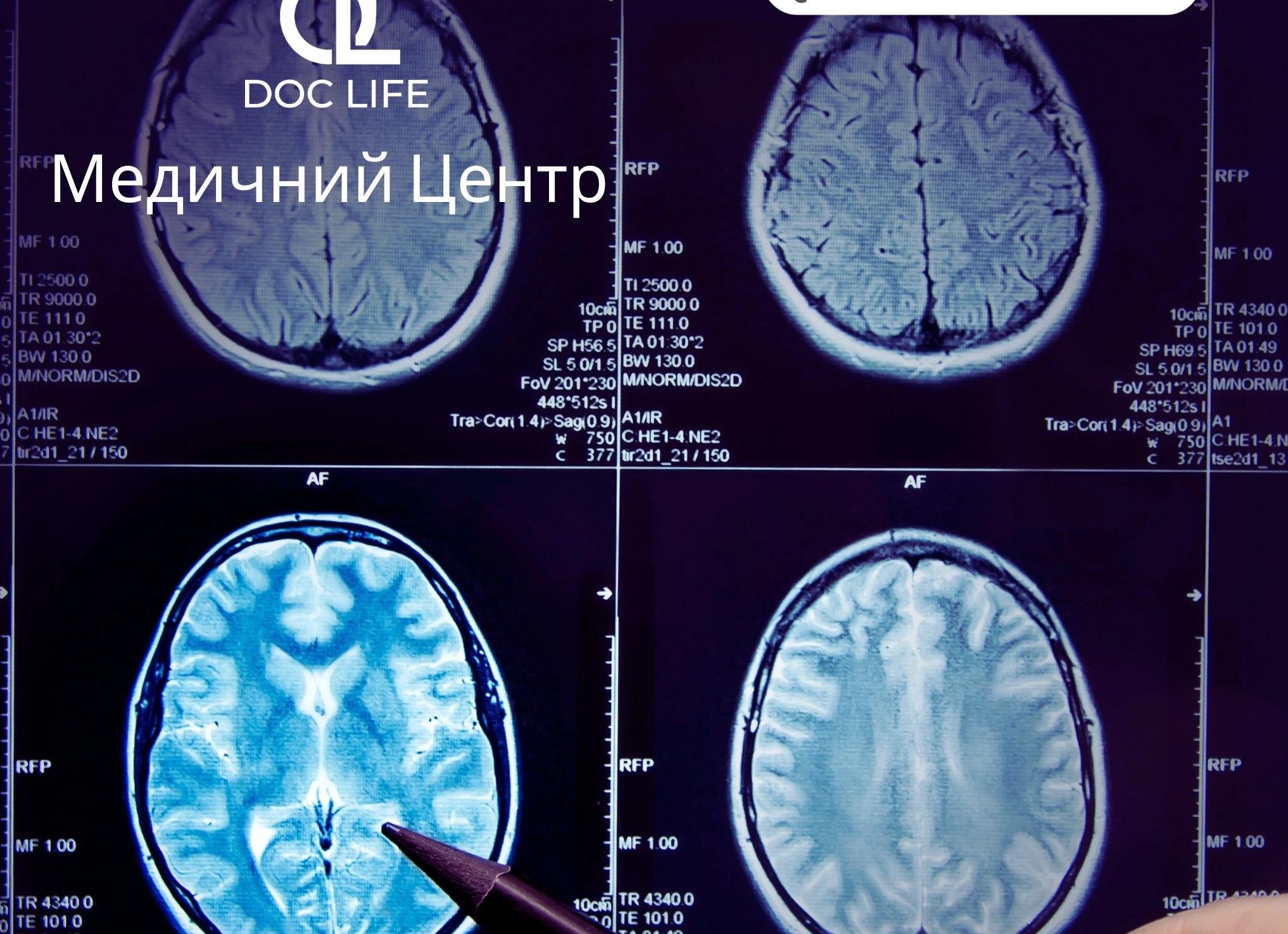 Синусопатия головного мозга: причины, симптомы и лечение