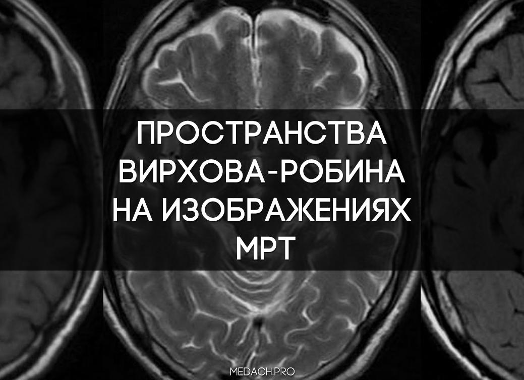 Расширенные периваскулярные пространства Вирхова-Робина: норма и патология
