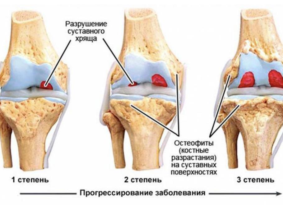 Артроз коленного сустава 2 степени — лечение с помощью лфк и упражнений