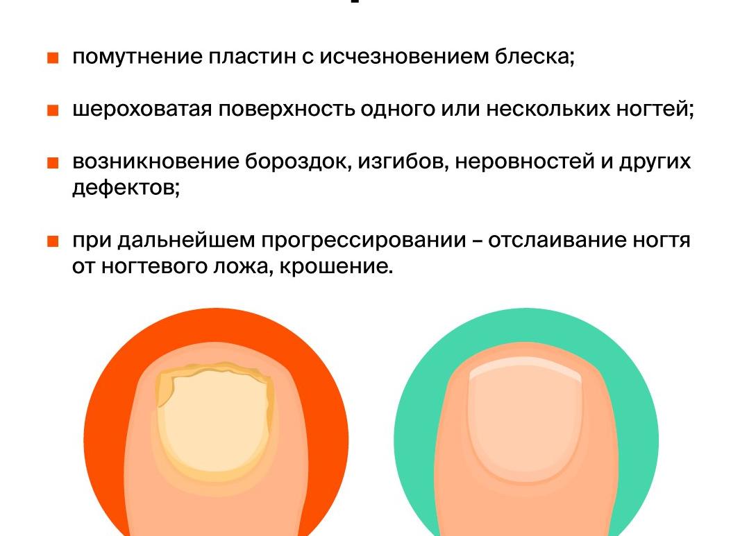 Грибок на руках — причины и пути заражения, диагностика, методы лечения и профилактические меры