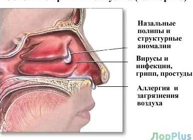 Причины гайморита у детей и взрослых — первые проявления