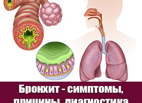 Симптомы аллергического бронхита у взрослых — диагностика и лечение
