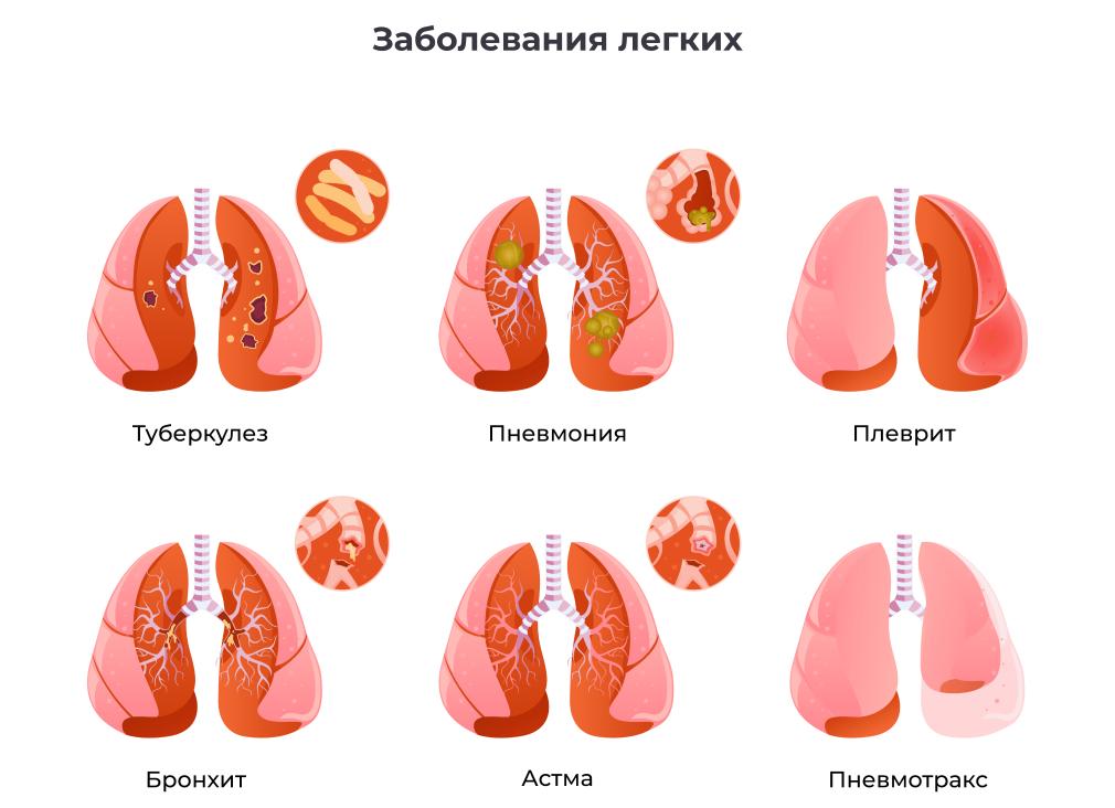 Туберкулезный плеврит легких — лечение