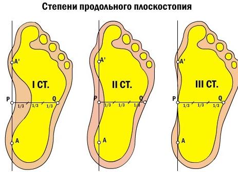3 степени продольного плоскостопия — симптомы у детей и взрослых, лечение