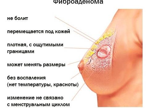 Фибромиома молочной железы