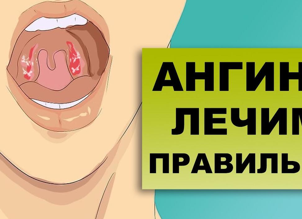 Лечение ангины у взрослых в домашних условиях медикаментозными и народными средствами