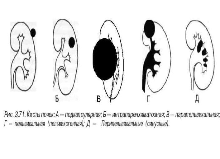 Простая и сложная киста почек, их симптомы и опасности
