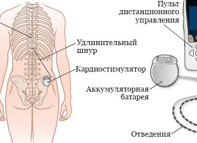 Все про опоясывающую боль в пояснице