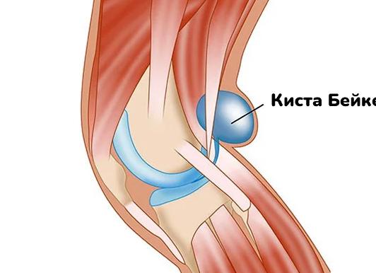 Киста Бейкера коленного сустава — причины и отзывы о лечении