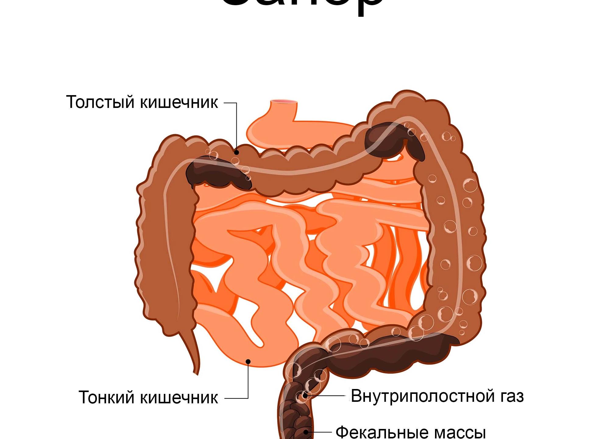 Причины возникновения запоров у взрослых и детей