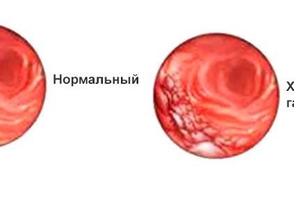 Симптомы и лечение гиперацидного гастрита