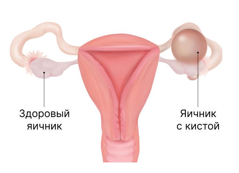 Киста яичника при беременности на ранних сроках