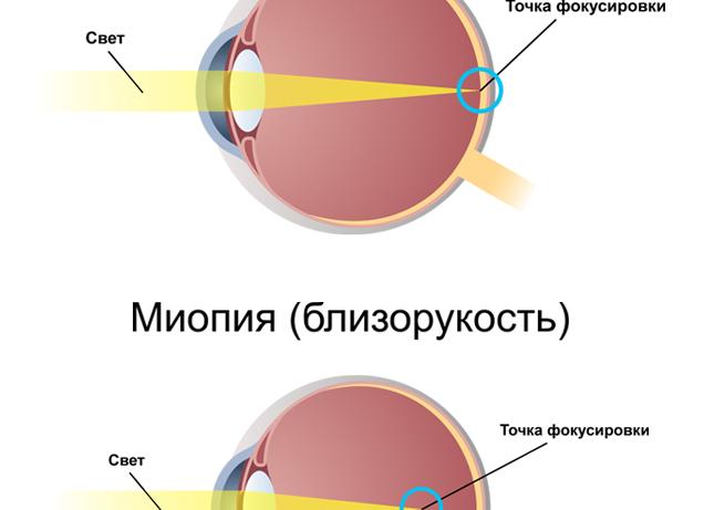 Миопатия – что это такое: симптомы и лечение
