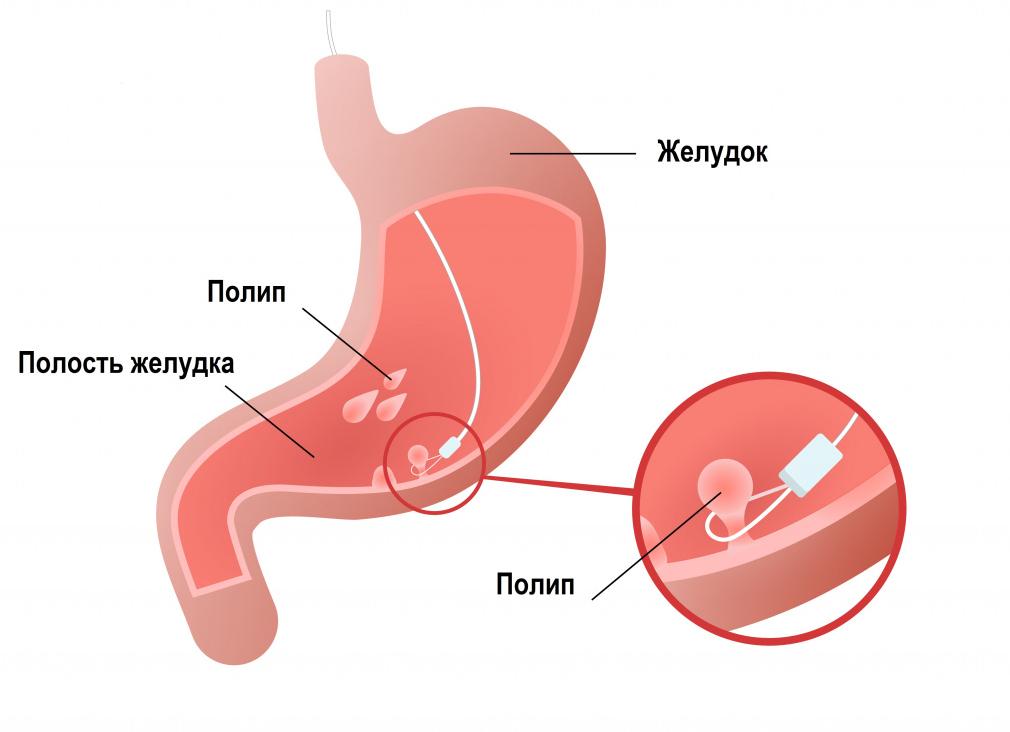 Почему в желудке образуются полипы? Как обнаружить это заболевание?