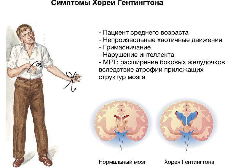 Хорея, как синдром и как самостоятельное заболевание