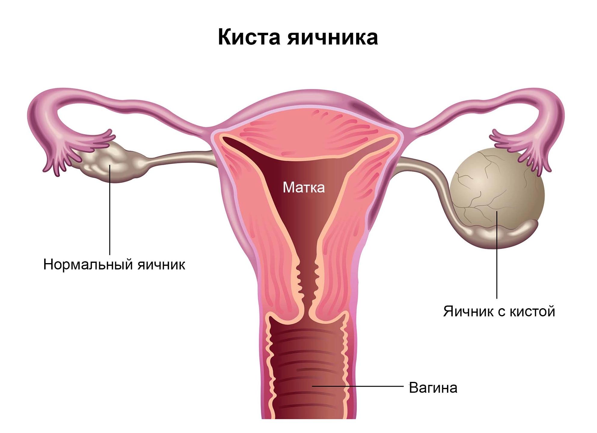 Признаки кисты яичника