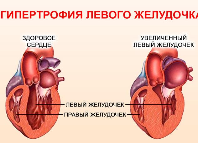 Гипертрофия левого предсердия — причины и симптомы заболевания, диагностика, методы лечения и прогноз