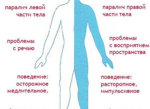 Обширный ишемический инсульт
