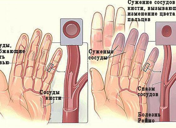 Патология сосудов болезнь Рейно — причины, симптомы и лечение