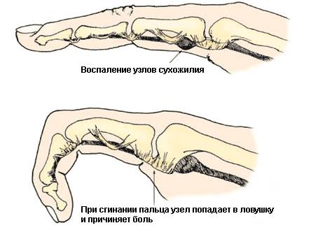 Почему болят суставы указательных пальцев
