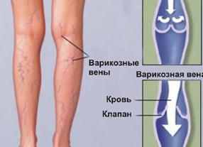 Причины ноющей боли в ногах