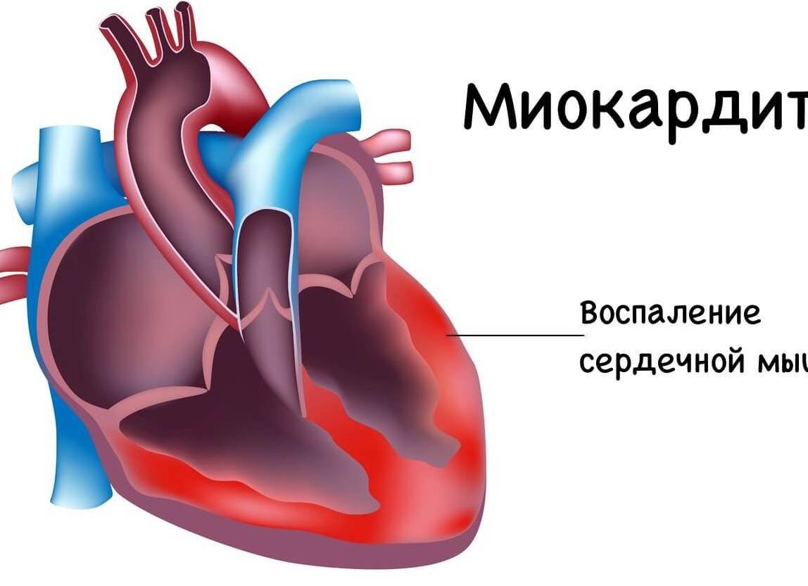 Симптомы и локализация боли в грудине при остеохондрозе