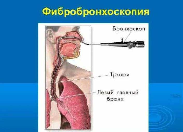 Бронхоскопия — показания к проведению и подготовка, методы исследования у детей или взрослых
