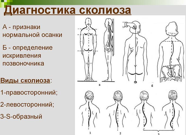 Лечение сколиоза 3 степени — упражнения и профилактика