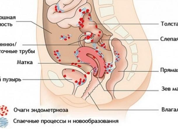 Последствия эндометриоза — распространение на другие органы и осложнения