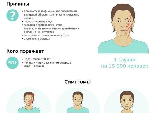 Все про лечение невралгии тройничного нерва