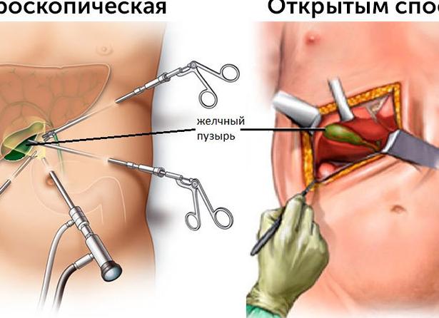 Лечение калькулезного холецистита хирургически, медикаментозно, диетой