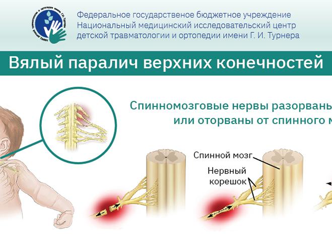 Центральный спастический паралич: анализ причин и симптомов
