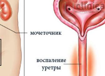 Жжение при мочеиспускании у женщин: причины и лечение