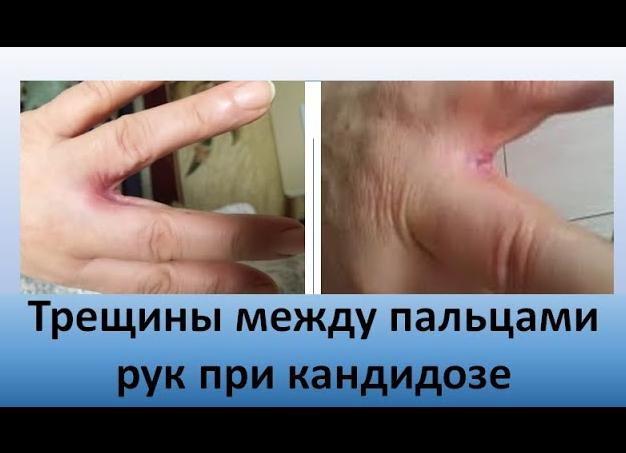 Грибок между пальцами рук