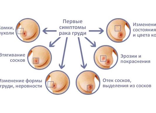 Карцинома молочной железы — причины и симптомы, диагностика, медикаментозное и хирургическое лечение