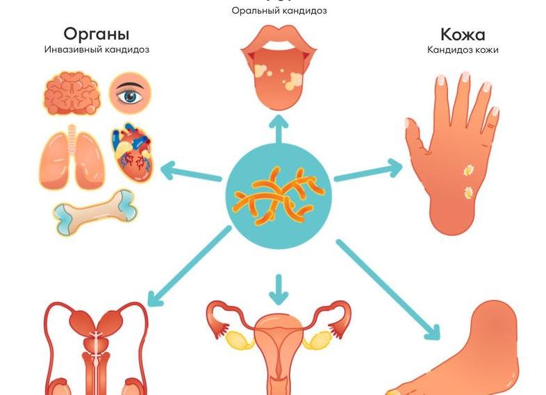 Причины, симптомы и лечение кандидоза прямой кишки