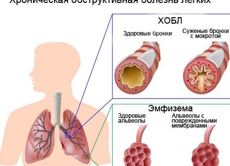 Эмфизема легких: симптомы и лечение