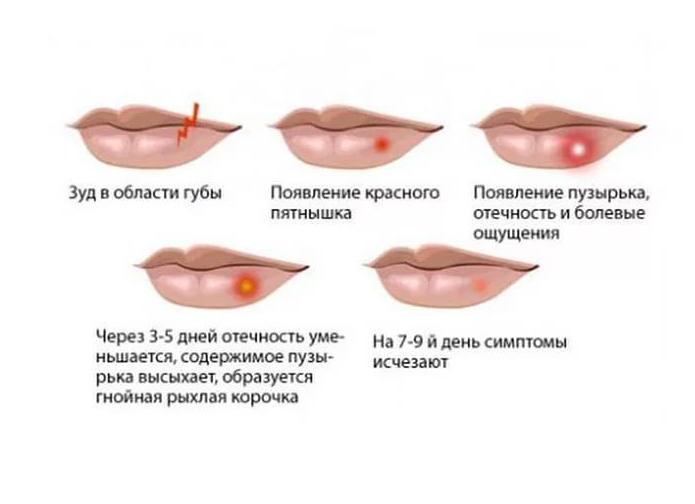 Как лечить простуду на губах быстро и эффективно в домашних условиях?