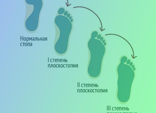 Какие причины приводят к возникновению плоскостопия у детей, подростков и взрослых