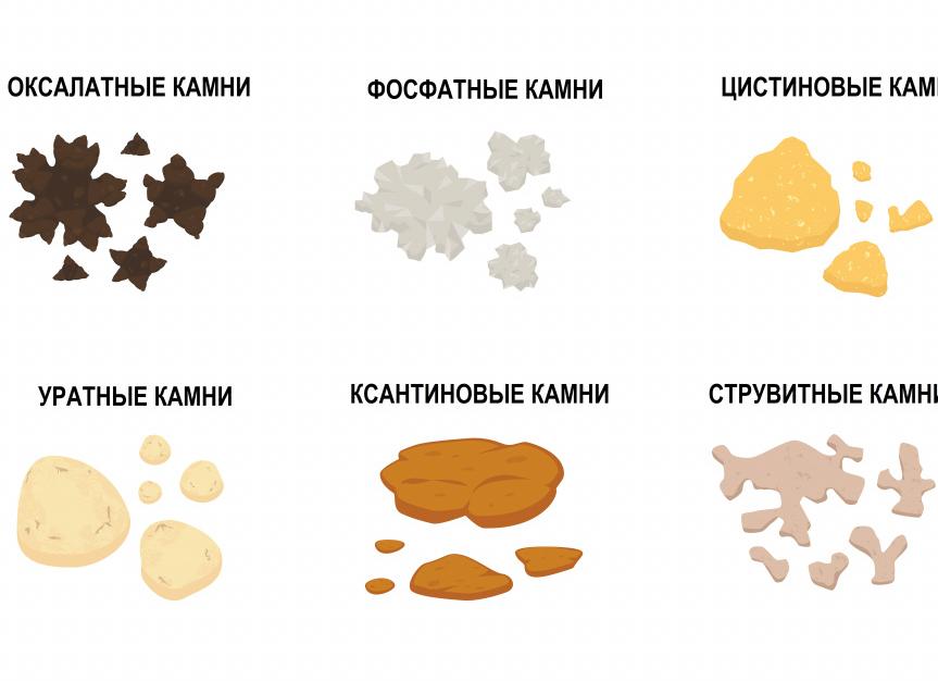 Каких видов бывают камни в почках?