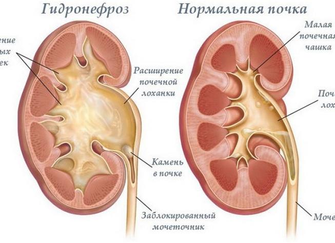 Почему опасен гидронефроз, и как с ним бороться?