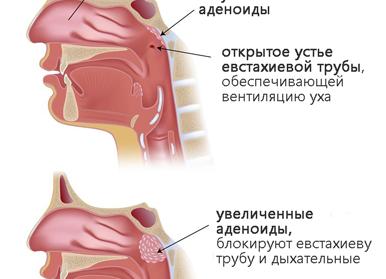 Признаки аденоидов у детей и взрослых — проявления и методы лечения