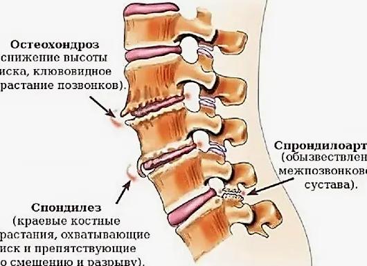 Артроз дугоотросчатых суставов поясничного отдела позвоночника