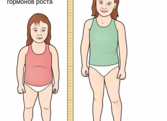 Гипофизарный нанизм – симптомы и признаки у детей и взрослых