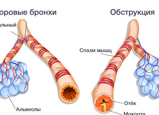 Как лечить обструктивный бронхит