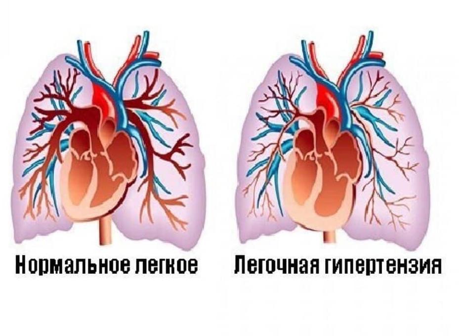 Легочная гипертензия – что это такое: степени и лечение заболевания