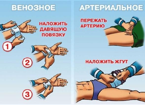 Наложение жгута при артериальном кровотечении в летнее и зимнее время — правила и возможные ошибки