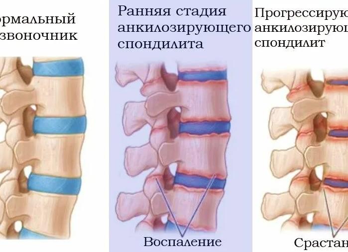 Причины болезни Бехтерева у женщин и мужчин