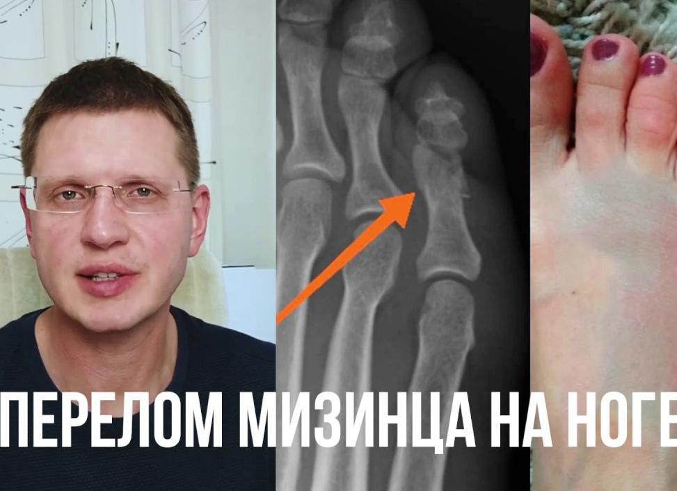 Что делать при переломе мизинца на ноге после травмы